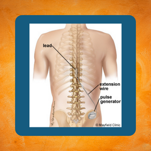 SMS - Spinal Cord Stimulator - clinical and cost-effectiveness